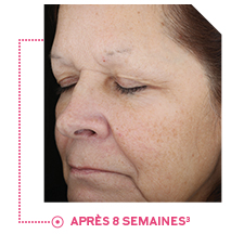 Photo d’une participante illustrant l’amélioration moyenne de la pigmentation après 8 semaines 