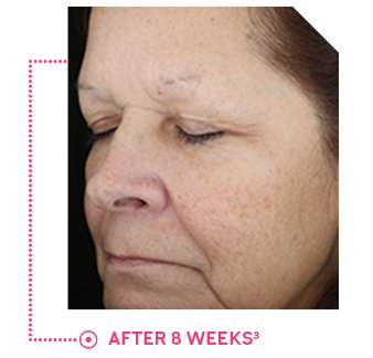 Panelist photo reflects average improvement in pigmentation after 8 weeks of use