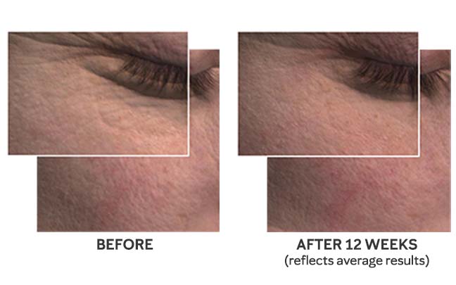 Detailed before and after snapshots of the skin around the eye show wrinkles and fine lines appearing less noticeable to illustrate average results from using Mary Kay’s new TimeWise Miracle Set 3D.