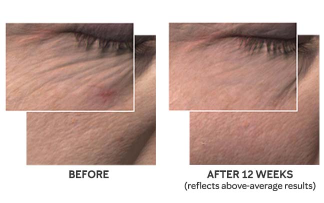 Detailed before and after snapshots of the skin around the eye show wrinkles and fine lines appearing less noticeable to illustrate average results from using Mary Kay’s new TimeWise Miracle Set 3D.
