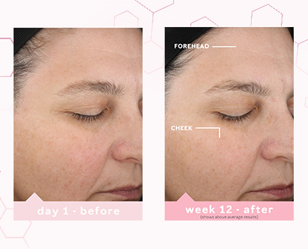 Day 1 and week 12 before and after images showing above average skin improvement on the forehead and cheek after using TimeWise Miracle Set
