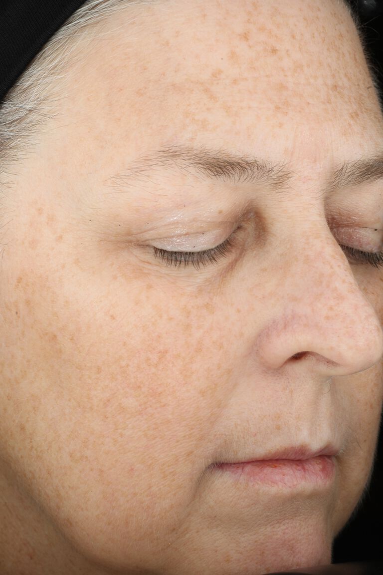 Week 12 of woman A after application of Mary Kay TimeWise Mircale Set.